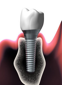 integrated dental implant